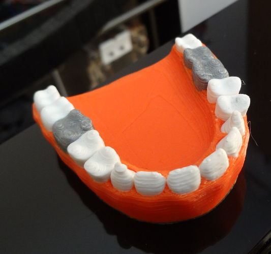 Teeth with a silver teeth prothesis 3D Print 120142
