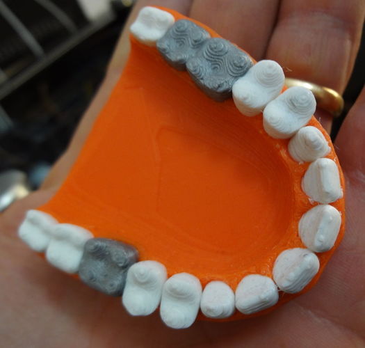 Teeth with a silver teeth prothesis 3D Print 120144