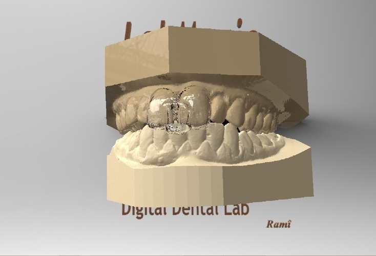 Digital NTI Splint 3D Print 126936 Digital NTI Splint 3D Print 126936
