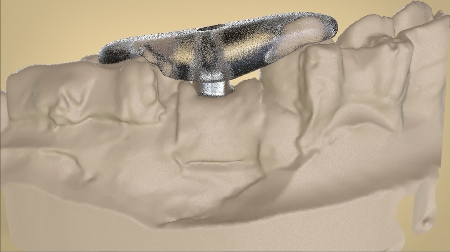 Digital Anatomical Screw Retained Abutment 3D Print 127117 Digital Anatomical Screw Retained Abutment 3D Print 127117
