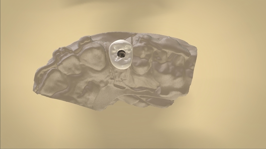 Digital Anatomical Screw Retained Abutment 3D Print 127123 Digital Anatomical Screw Retained Abutment 3D Print 127123