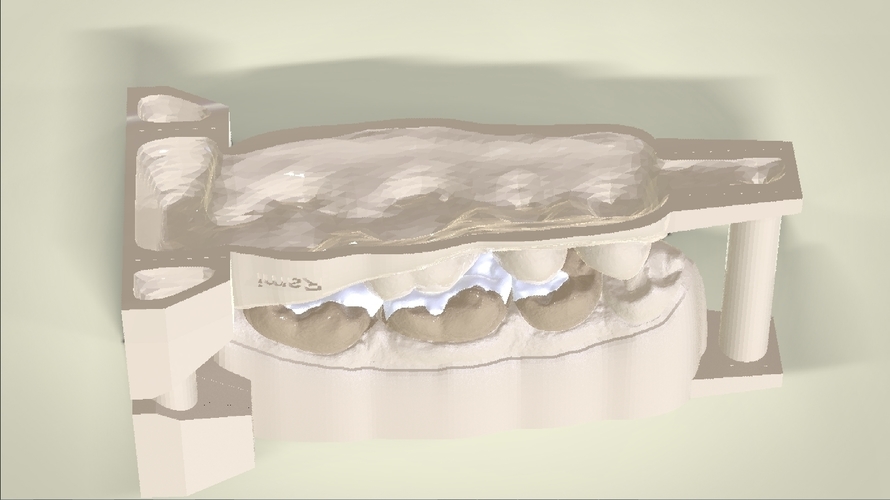 Digital Dental Inlay Bridge Model for 3D Printing 3D Print 128443 Digital Dental Inlay Bridge Model for 3D Printing 3D Print 128443