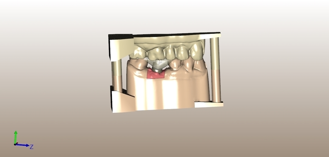 Digital Dental Implant Model with Positioning Guide 3D Print 128760 Digital Dental Implant Model with Positioning Guide 3D Print 128760