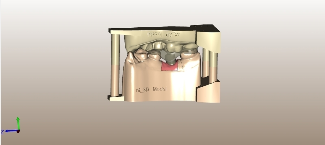 Digital Dental Implant Model with Positioning Guide 3D Print 128761 Digital Dental Implant Model with Positioning Guide 3D Print 128761