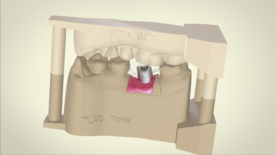 Digital Dental Implant Model with Positioning Guide 3D Print 128764 Digital Dental Implant Model with Positioning Guide 3D Print 128764