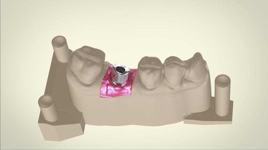 Digital Dental Implant Model with Positioning Guide 3D Print 128766 Digital Dental Implant Model with Positioning Guide 3D Print 128766