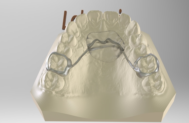 Digital Nance Holder Appliance 3D Print 131802 Digital Nance Holder Appliance 3D Print 131802