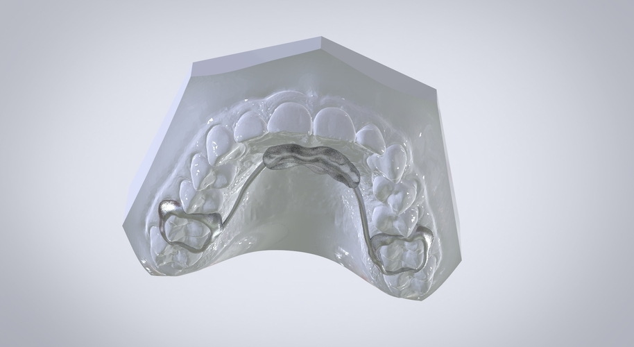 Digital Nance Holder Appliance 3D Print 131807 Digital Nance Holder Appliance 3D Print 131807