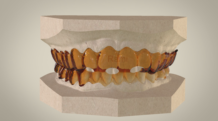 Digital Ortho Tooth Positioner 3D Print 141411 Digital Ortho Tooth Positioner 3D Print 141411