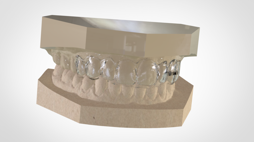 Mini Deprogrammer Splint 3D Print 146726 Mini Deprogrammer Splint 3D Print 146726