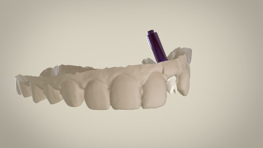 Digital Custom Dental Abutment 3D Print 147518 Digital Custom Dental Abutment 3D Print 147518