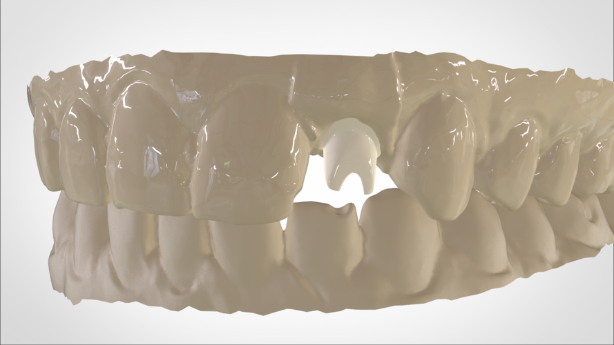 Digital Custom Dental Abutment 3D Print 147527 Digital Custom Dental Abutment 3D Print 147527