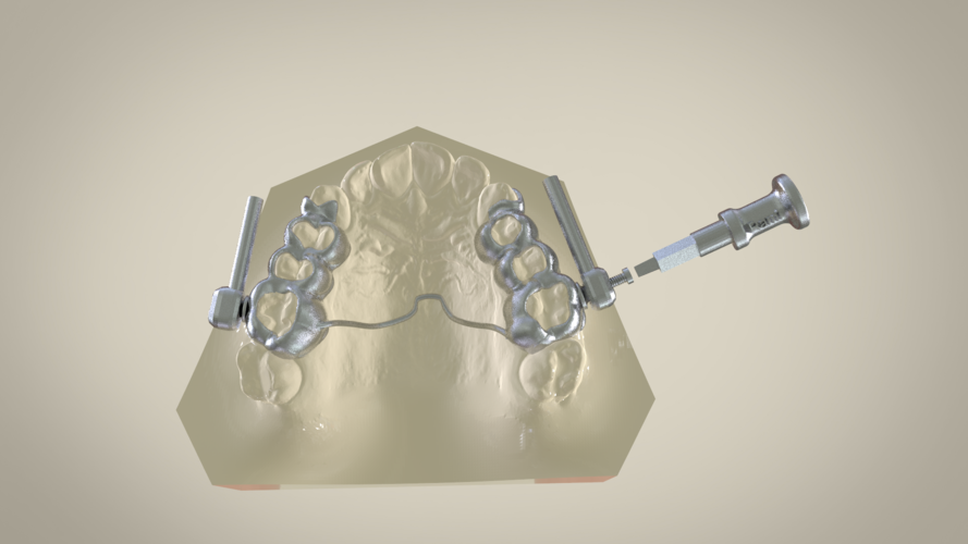 Herbst Cast Splint (Orthodontics) 3D Print 147538 Herbst Cast Splint (Orthodontics) 3D Print 147538