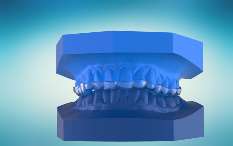 Digital Ortho Anterior Repositioner Splint 3D Print 155213 Digital Ortho Anterior Repositioner Splint 3D Print 155213