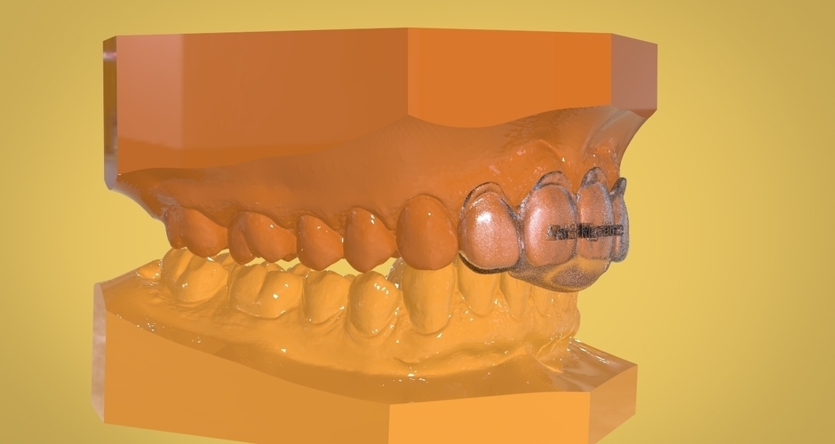 Digital Anti Migraine Appliance 3D Print 157187 Digital Anti Migraine Appliance 3D Print 157187