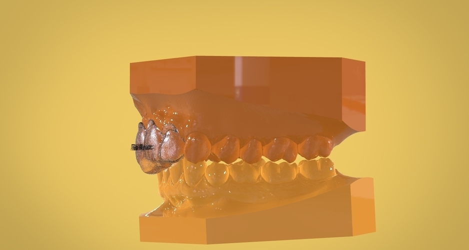 Digital Anti Migraine Appliance 3D Print 157189 Digital Anti Migraine Appliance 3D Print 157189