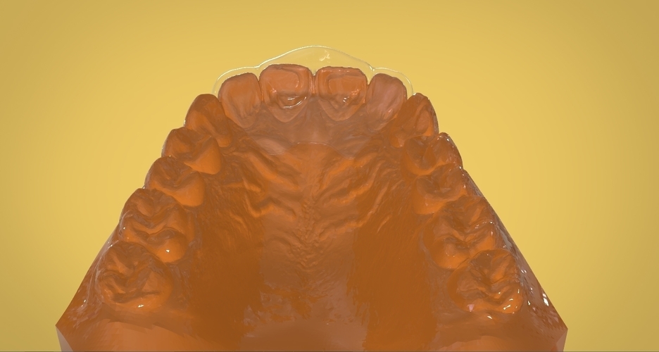 Digital Anti Migraine Appliance 3D Print 157196 Digital Anti Migraine Appliance 3D Print 157196