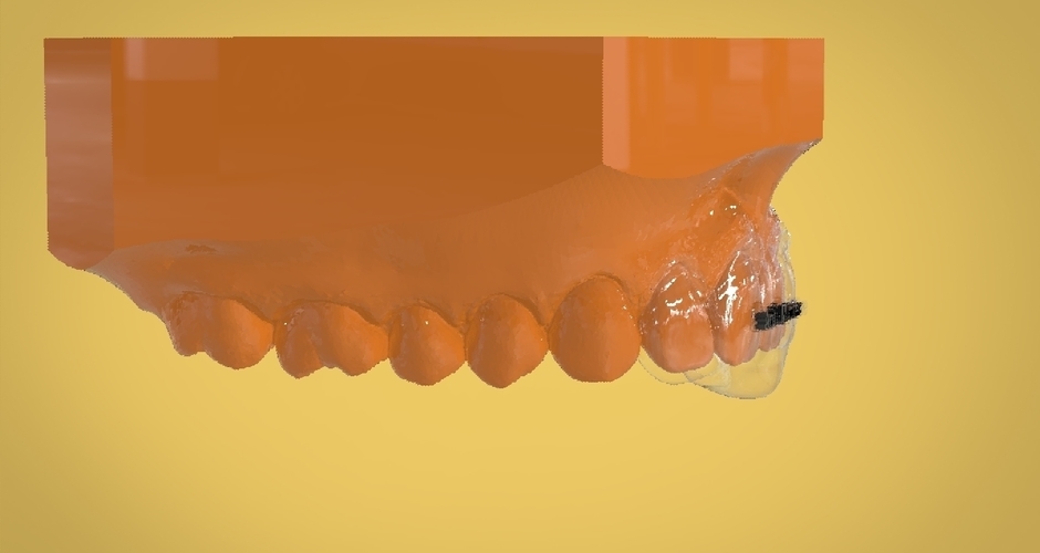 Digital Anti Migraine Appliance 3D Print 157198 Digital Anti Migraine Appliance 3D Print 157198