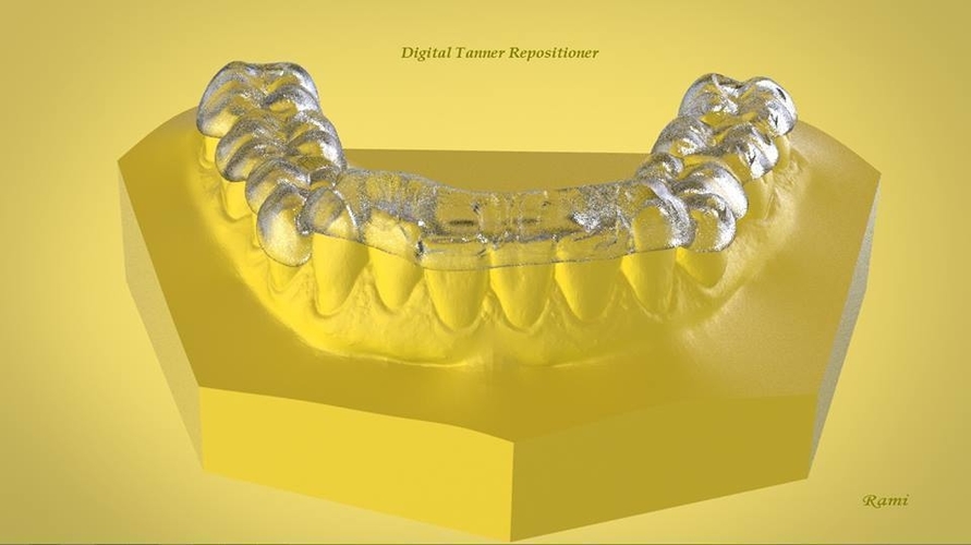 Digital OrthoTanner Repositioner 3D Print 158755 Digital OrthoTanner Repositioner 3D Print 158755