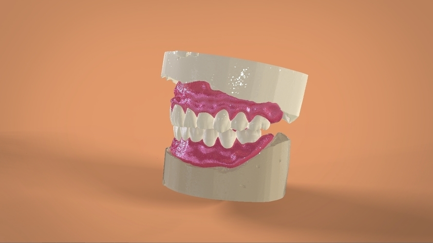 Digital Full Dentures 3D Print 159106 Digital Full Dentures 3D Print 159106