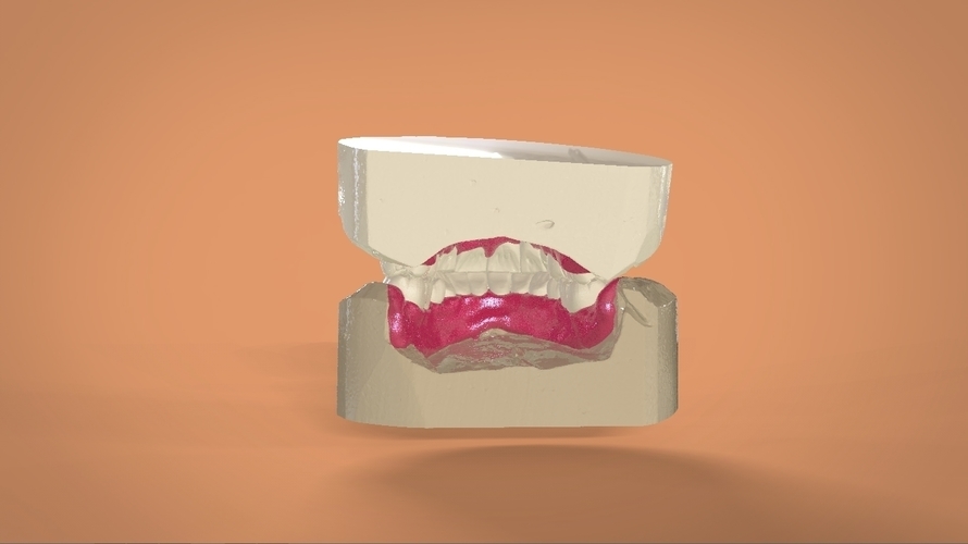 Digital Full Dentures 3D Print 159107 Digital Full Dentures 3D Print 159107