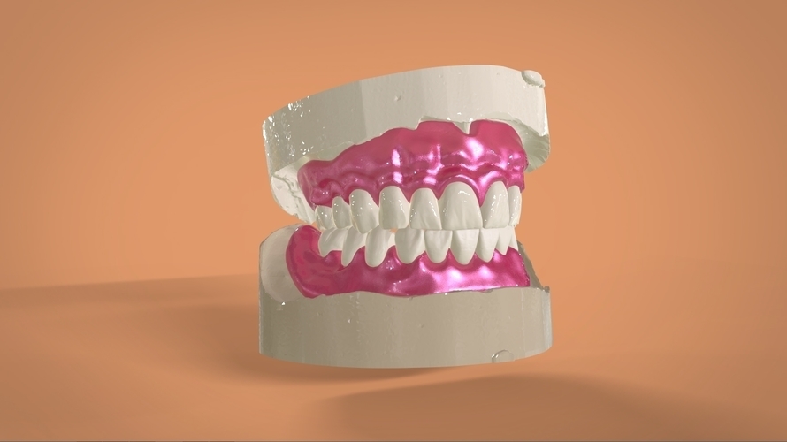 Digital Full Dentures 3D Print 159108 Digital Full Dentures 3D Print 159108