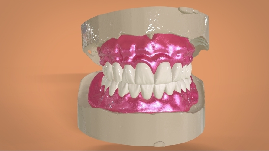 Digital Full Dentures 3D Print 159112 Digital Full Dentures 3D Print 159112
