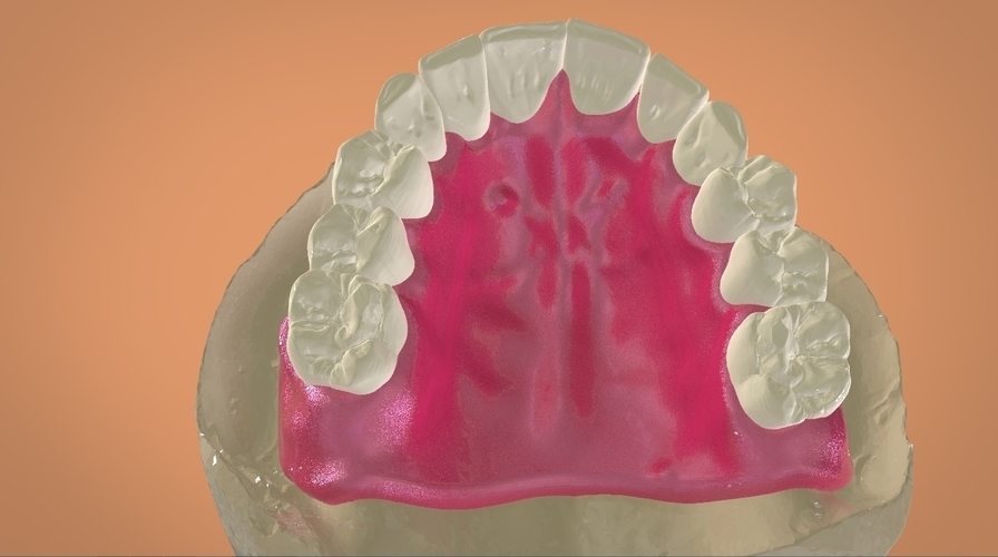 Digital Full Dentures 3D Print 159115 Digital Full Dentures 3D Print 159115