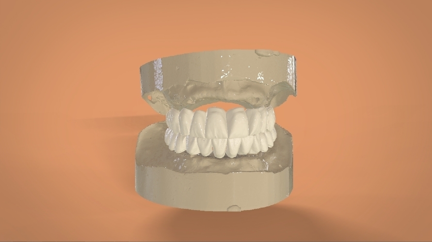 Digital Full Dentures 3D Print 159120 Digital Full Dentures 3D Print 159120
