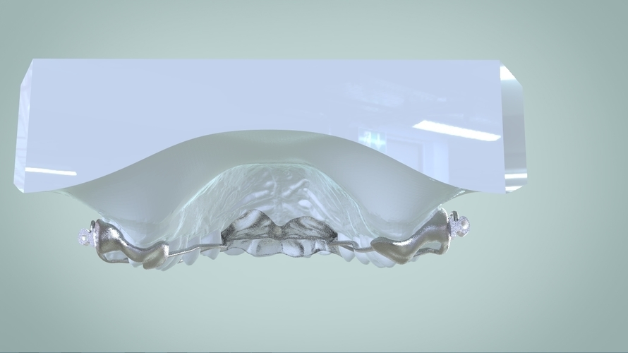 Digital Ortho Rick-a-Nator Appliance 3D Print 159632 Digital Ortho Rick-a-Nator Appliance 3D Print 159632