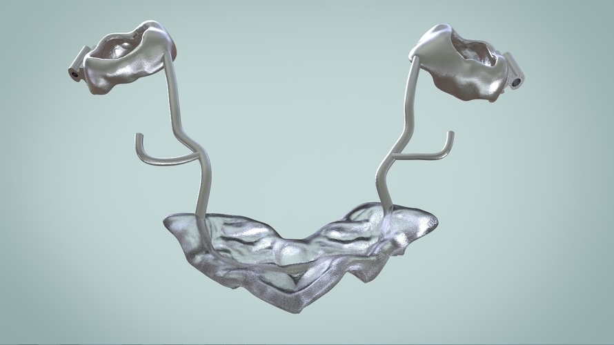 Digital Ortho Rick-a-Nator Appliance 3D Print 159633 Digital Ortho Rick-a-Nator Appliance 3D Print 159633