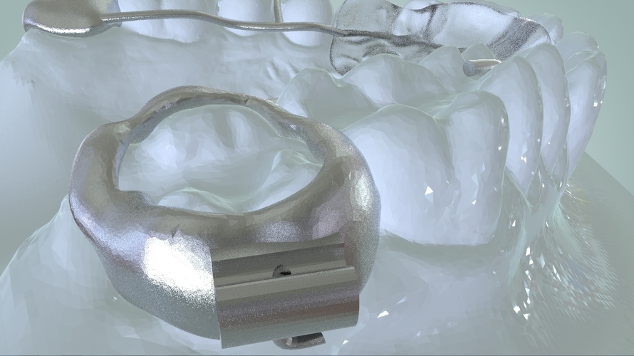 Digital Ortho Rick-a-Nator Appliance 3D Print 159636 Digital Ortho Rick-a-Nator Appliance 3D Print 159636