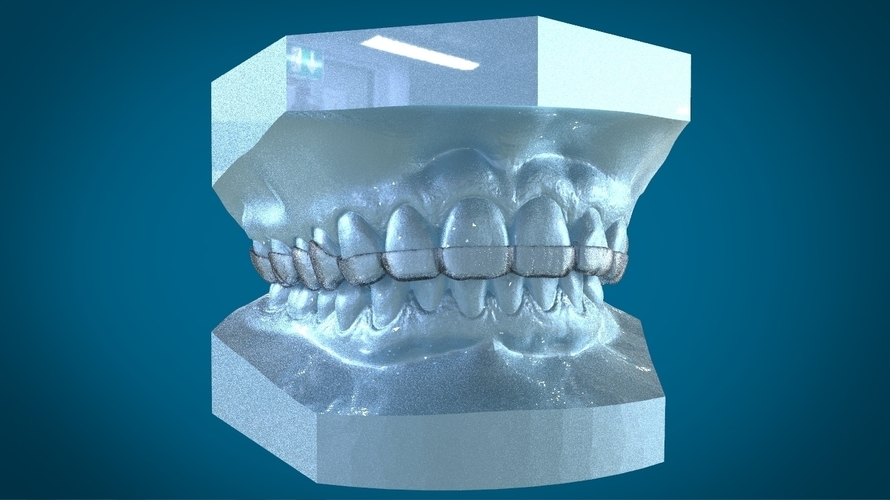 Digital Dental Dayguard Splint 3D Print 159679 Digital Dental Dayguard Splint 3D Print 159679