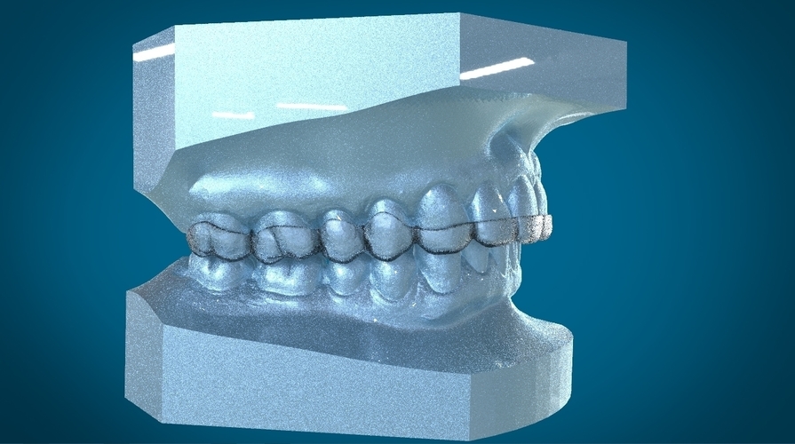 Digital Dental Dayguard Splint 3D Print 159680 Digital Dental Dayguard Splint 3D Print 159680