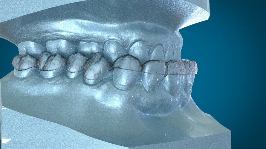 Digital Dental Dayguard Splint 3D Print 159685 Digital Dental Dayguard Splint 3D Print 159685