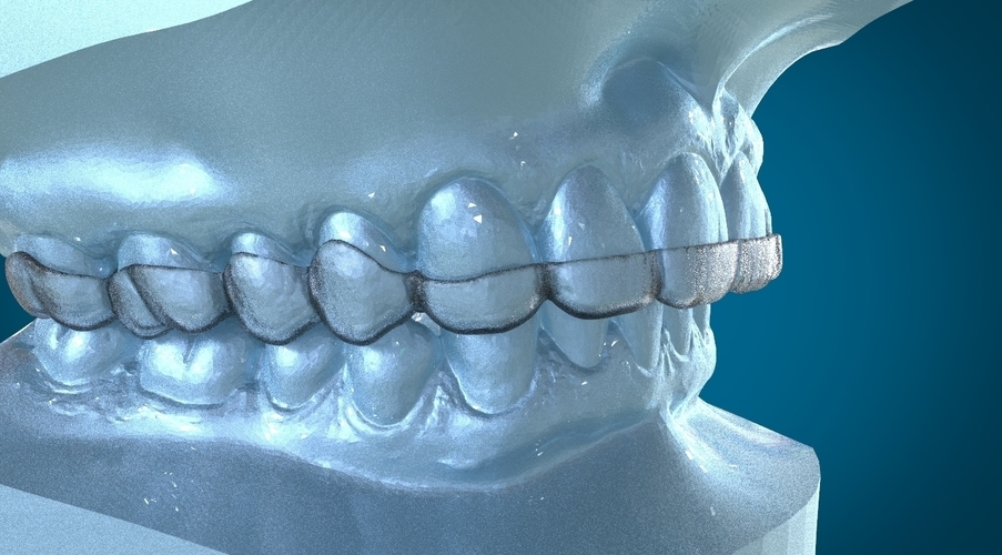 Digital Dental Dayguard Splint 3D Print 159686 Digital Dental Dayguard Splint 3D Print 159686