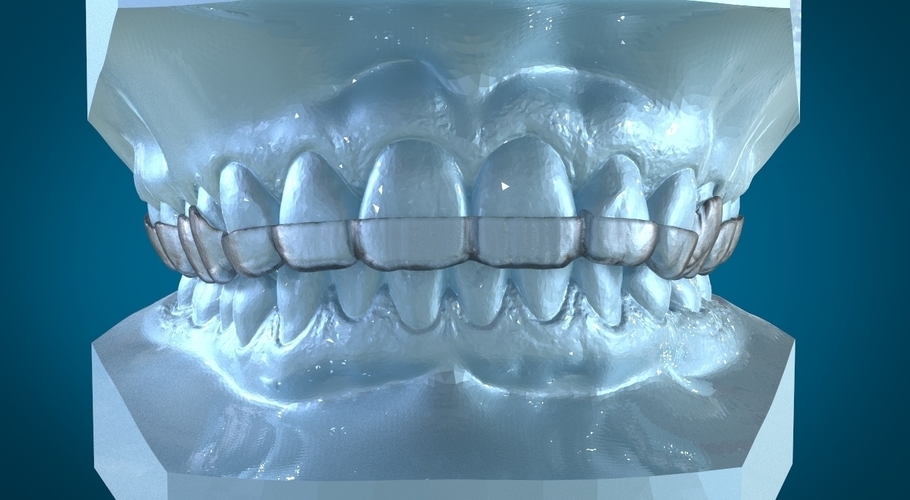 Digital Dental Dayguard Splint 3D Print 159687 Digital Dental Dayguard Splint 3D Print 159687