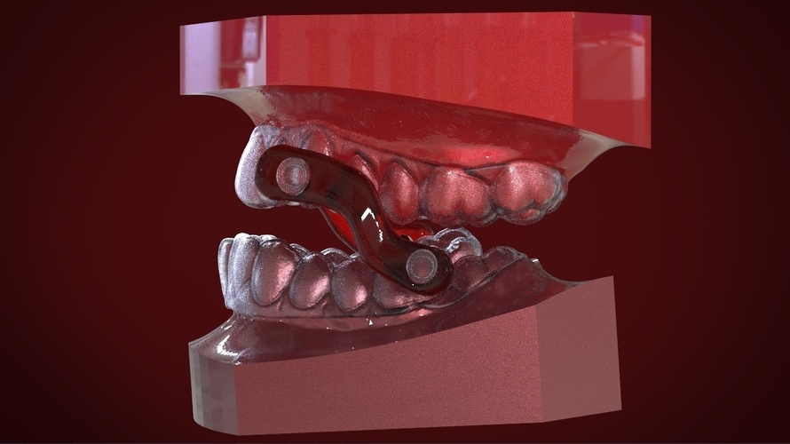 Digital Sleep Apnea Mouthguard 3D Print 159852 Digital Sleep Apnea Mouthguard 3D Print 159852