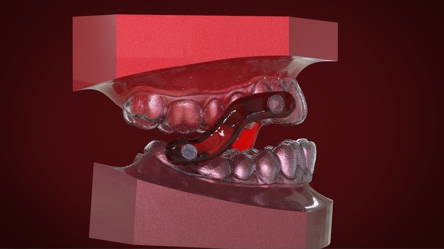 Digital Sleep Apnea Mouthguard 3D Print 159854 Digital Sleep Apnea Mouthguard 3D Print 159854