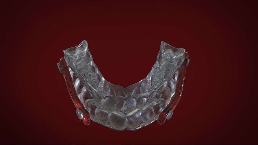 Digital Sleep Apnea Mouthguard 3D Print 159858 Digital Sleep Apnea Mouthguard 3D Print 159858