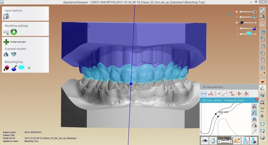Digital Dental Bleaching Tray 3D Print 160352 Digital Dental Bleaching Tray 3D Print 160352