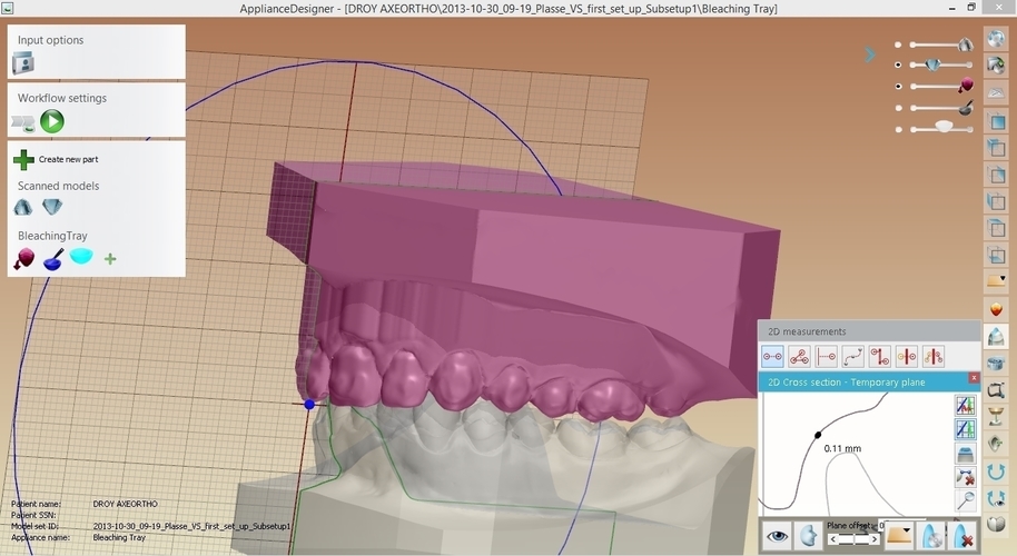Digital Dental Bleaching Tray 3D Print 160354 Digital Dental Bleaching Tray 3D Print 160354