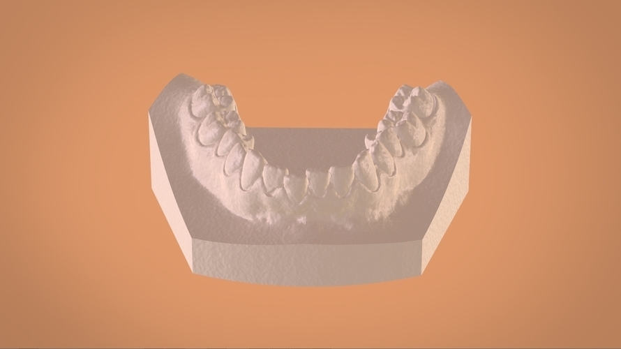 Digital Dental Bleaching Tray 3D Print 160355 Digital Dental Bleaching Tray 3D Print 160355
