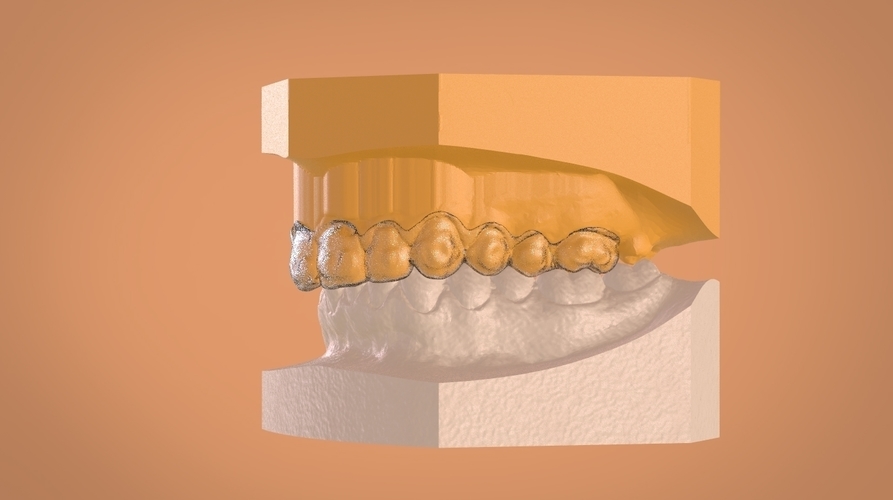 Digital Dental Bleaching Tray 3D Print 160357 Digital Dental Bleaching Tray 3D Print 160357