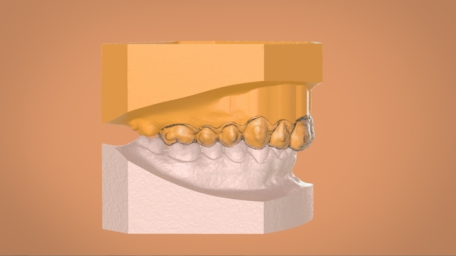Digital Dental Bleaching Tray 3D Print 160358 Digital Dental Bleaching Tray 3D Print 160358