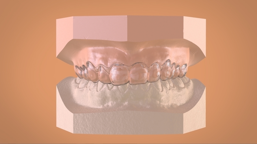 Digital Dental Bleaching Tray 3D Print 160362 Digital Dental Bleaching Tray 3D Print 160362