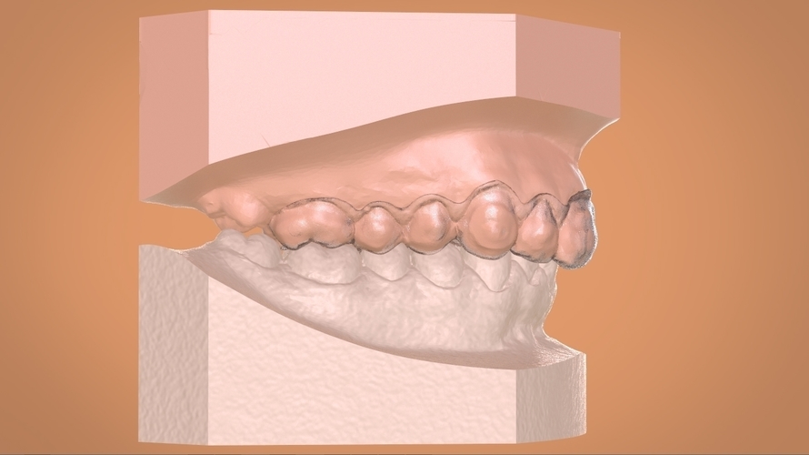 Digital Dental Bleaching Tray 3D Print 160363 Digital Dental Bleaching Tray 3D Print 160363