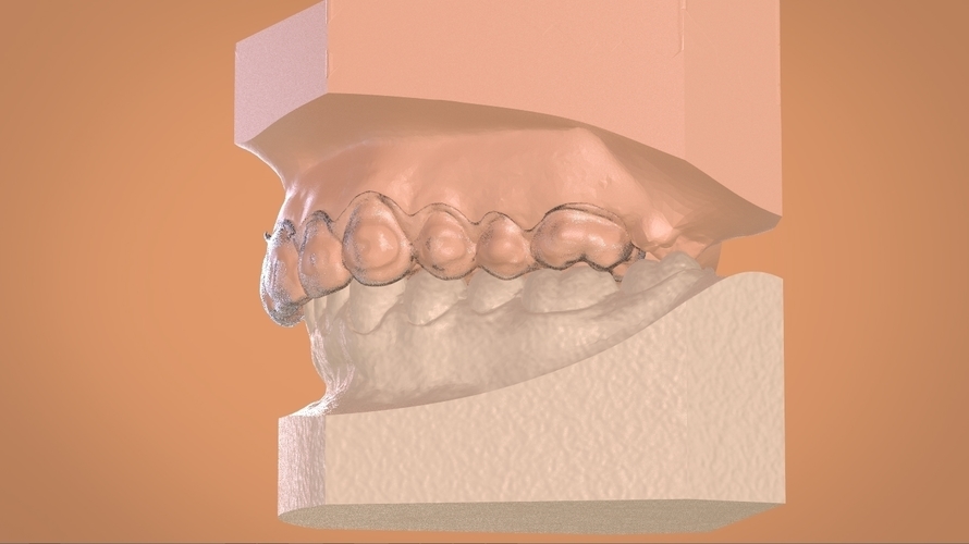 Digital Dental Bleaching Tray 3D Print 160364 Digital Dental Bleaching Tray 3D Print 160364