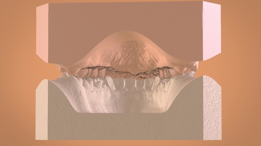 Digital Dental Bleaching Tray 3D Print 160365 Digital Dental Bleaching Tray 3D Print 160365