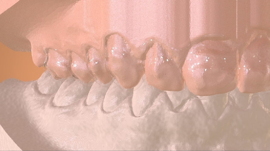 Digital Dental Bleaching Tray 3D Print 160374 Digital Dental Bleaching Tray 3D Print 160374